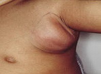 Как лечить лимфовузли под подмышками?